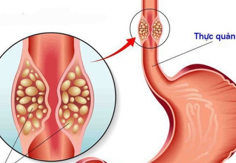 Tổng quan về ung thư thực quản 